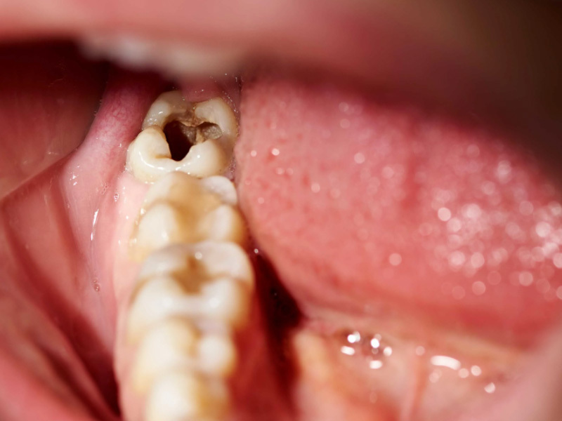 Đau nhức răng hàm trong