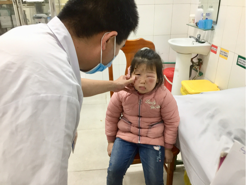 Bé gái nhập viện cấp cứu sau khi rửa mắt bằng nước lá trầu