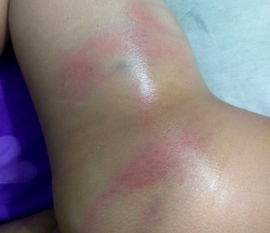 Đi vệ sinh trong quần, bé gái 4 tuổi bị cô giáo đánh bầm tím cơ thể