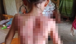 Bé gái 7 tuổi bị hàng xóm tạt nước sôi gây bỏng nặng do mâu thuẫn của người lớn