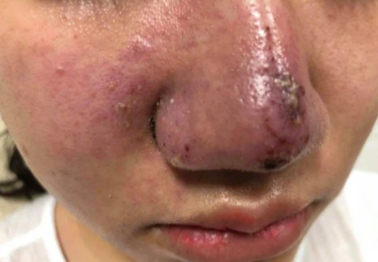 Tiêm filler nâng mũi tại spa, thiếu nữ 16 tuổi nhận cái kết đắng