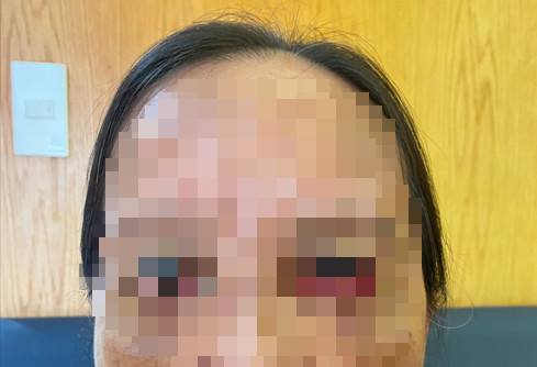 Cụ bà U70 nhận trái đắng sau khi cắt mí mắt tại 1 spa