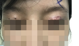 Người phụ nữ gặp tai biến nghiêm trọng khi cắt mí mắt tại thẩm mỹ viện