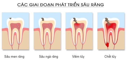 sâu răng hàm có lỗ