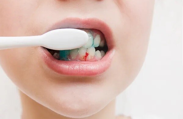 viêm lợi chảy máu chân răng