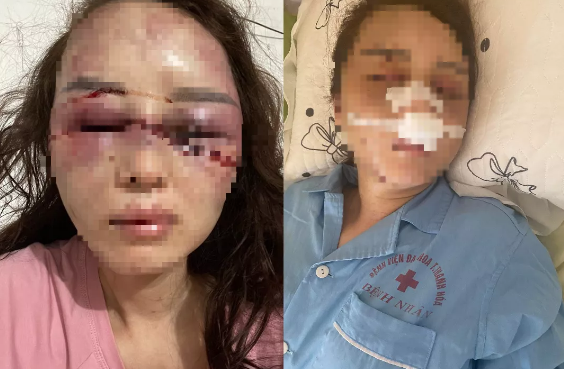 Cán bộ quản lý thị trường ở Thanh Hóa đánh đập bạn gái dã man đã có vợ con