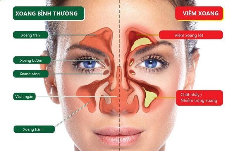 Viêm xoang bị ngạt mũi