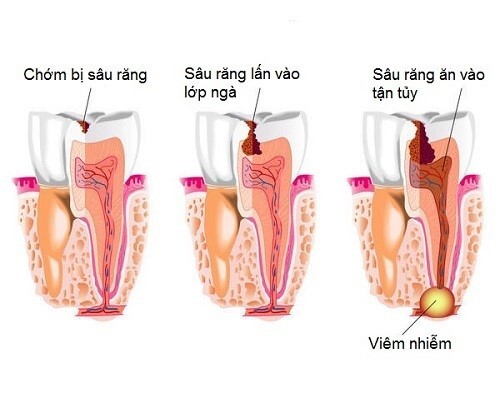 viêm chân răng khôn có mủ