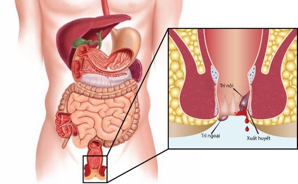 triệu chứng trĩ ngoại 