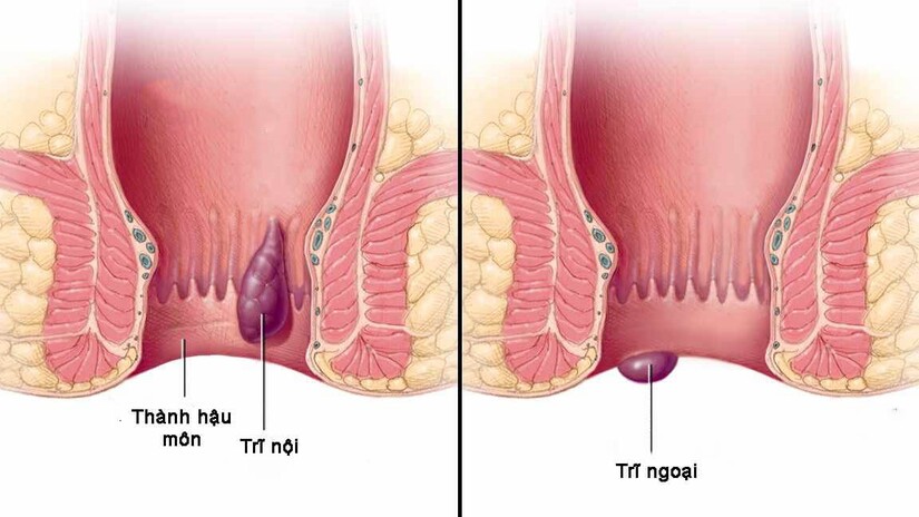 bị bệnh trĩ