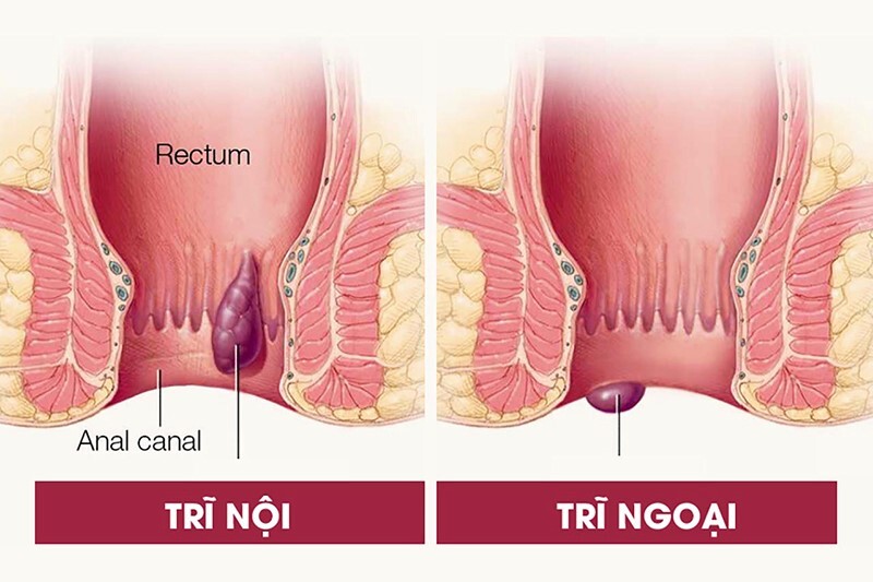 Tư vấn bệnh trĩ 