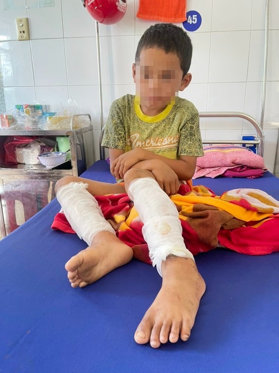 Quảng Bình: Một cháu bé bị bỏng độ 3 vì bố ruột dùng xăng và rơm đốt chân