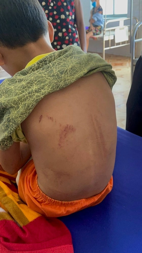 Quảng Bình: Một cháu bé bị bỏng độ 3 vì bố ruột dùng xăng và rơm đốt chân