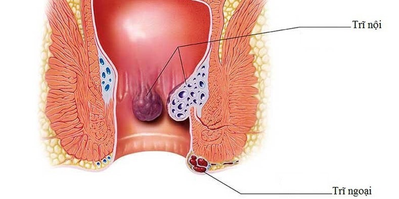 bệnh trĩ như thế nào