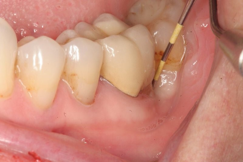Viêm chân răng hàm dưới