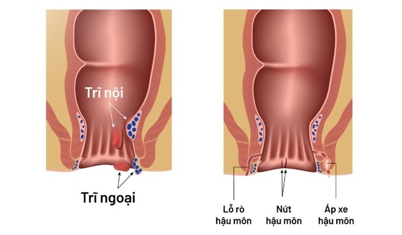 điều trị nứt kẽ hậu môn