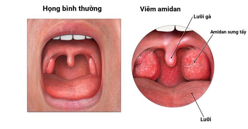 Viêm amidan cấp ở trẻ em