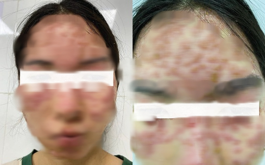 Detox da trị mụn tại spa, cô gái trẻ nhập viện với khuôn mặt biến dạng