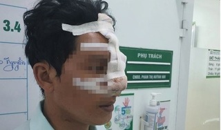 Bình Phước: Người đàn ông 33 tuổi bị bạn cắn đứt mũi vì can đánh nhau trên bàn nhậu