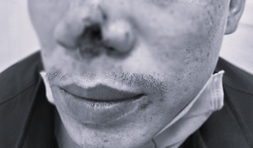 Bình Phước: Người đàn ông 33 tuổi bị bạn cắn đứt mũi trên bàn nhậu
