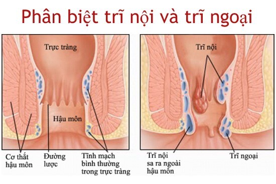 bệnh trĩ ngoại