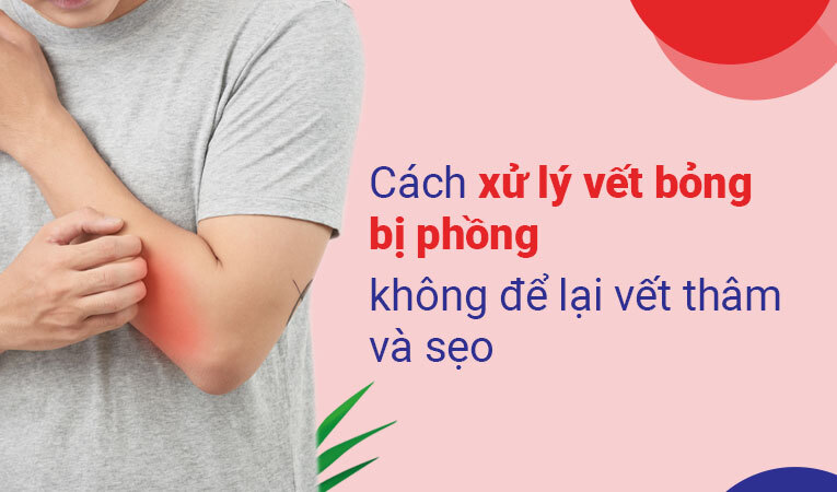 vết bỏng bị phồng