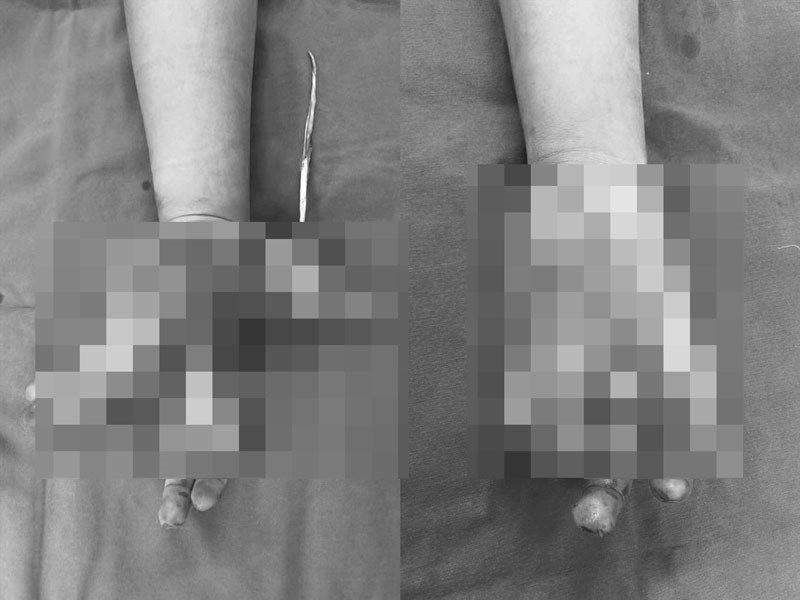 Hà Nội: Thiếu niên 14 tuổi bị nát tay do điện thoại bất ngờ phát nổ