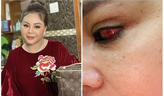 Nghệ sĩ Lê Giang rách giác mạc nặng, mắt tụ máu bầm do tai nạn