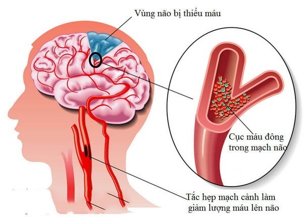 Cơn thiếu máu não thoáng qua