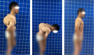 Phẫu thuật lấy lại hình dáng cho người đàn ông bị gù hơn 100 độ