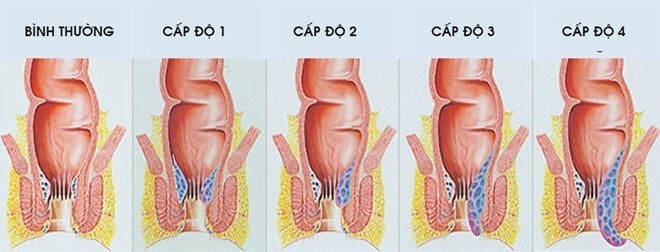 phương pháp trị bệnh trĩ 