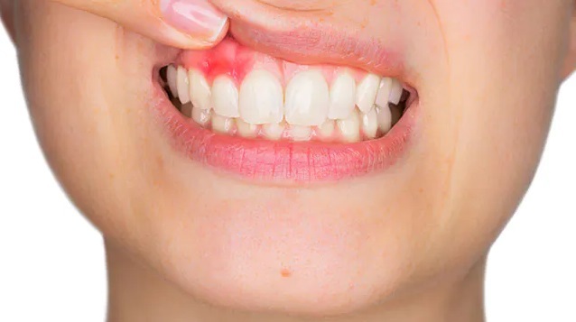 bệnh viêm nướu răng