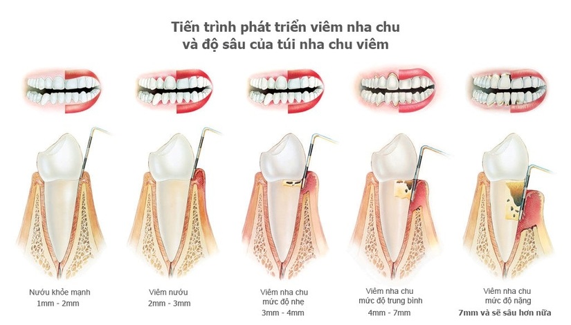 Viêm chân răng có mủ