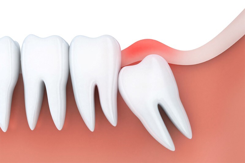 trị viêm lợi răng hàm