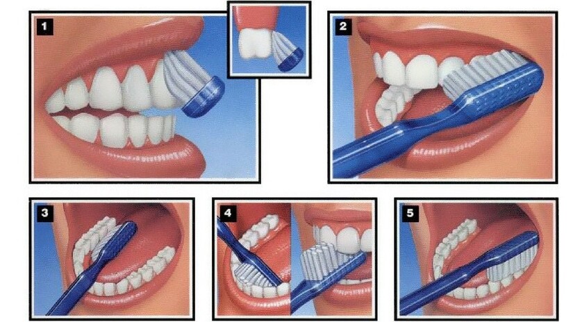 trị viêm lợi răng hàm