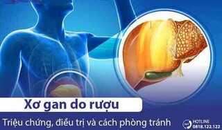 Xơ gan do rượu là bệnh gì? Nguyên nhân, Triệu chứng & Cách điều trị