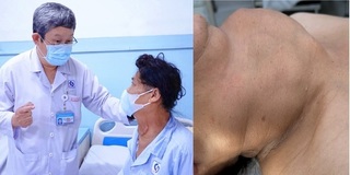  Đồng Tháp: Người phụ nữ mang khối u tuyến giáp khổng lồ suốt 30 năm