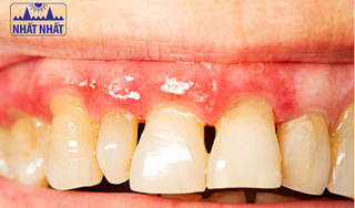 Nhận biết các giải pháp hiệu quả cho người bị viêm chân răng