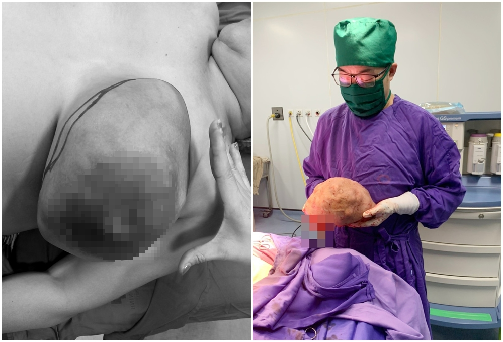 Bóc tách thành công khối u vú trái kích thước “khủng” nặng hơn 3kg cho phụ nữ 50 tuổi