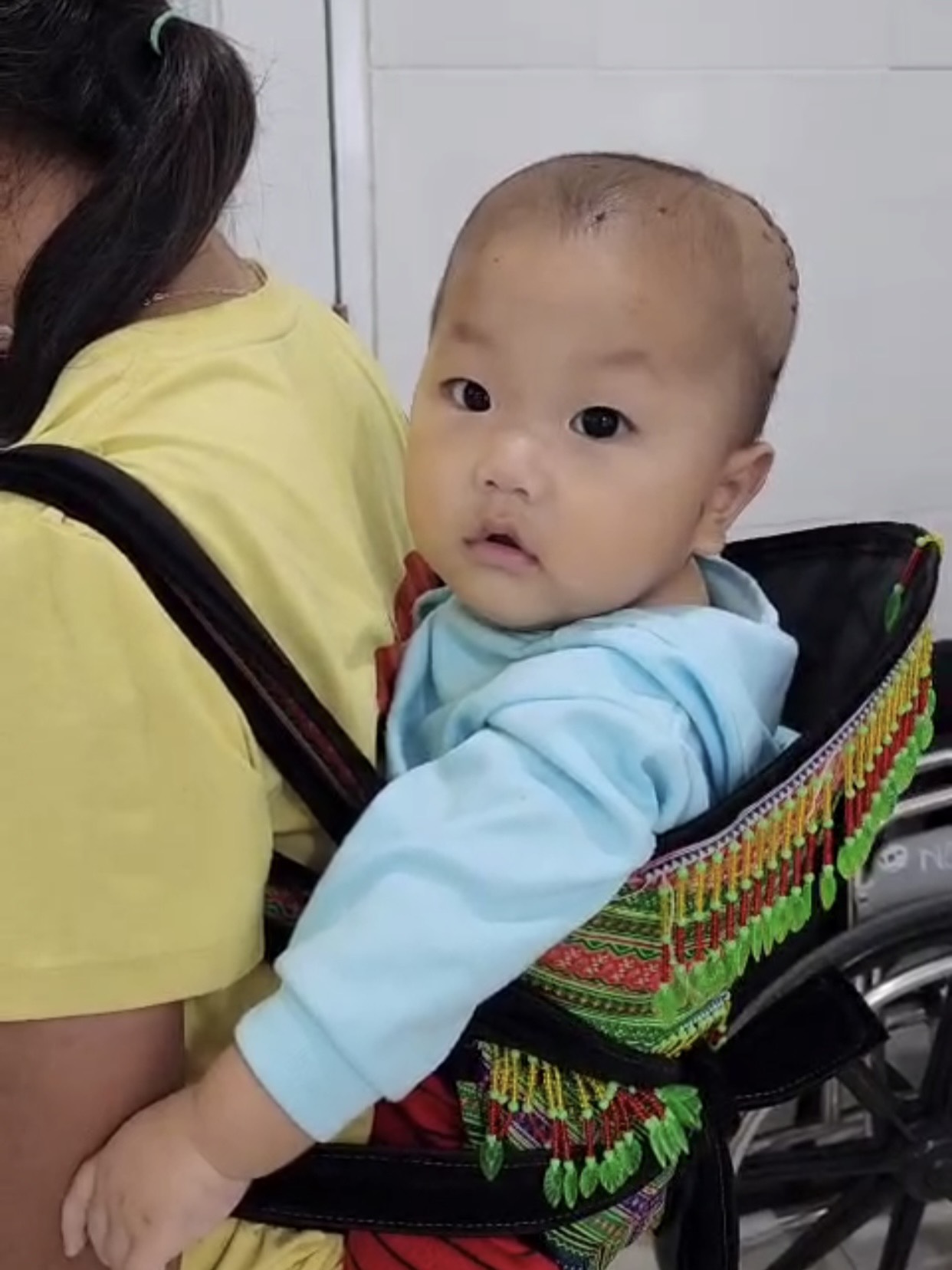 Phẫu thuật cấp cứu thành công bé trai 10 tháng tuổi bị ngã bể lún sọ