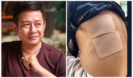 Nghệ sĩ hài Tấn Beo bất tỉnh sau cú ngã cầu thang, lưng và hông bị chấn thương nặng