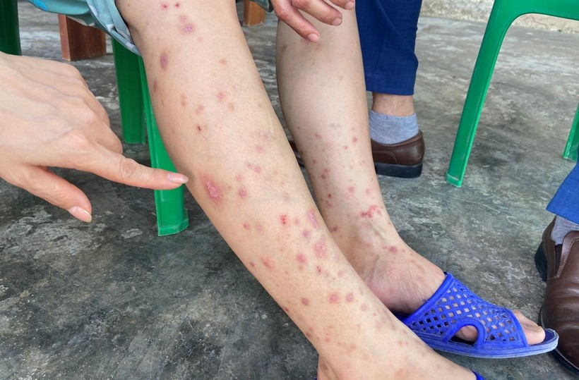 Hà Tĩnh: Hàng trăm người dân bị nổi sẩn khắp cơ thể do bọ chét cắn