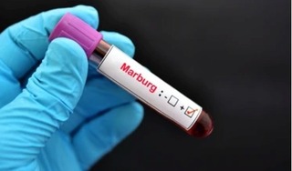 WHO lên tiếng cảnh báo đại dịch virus Marburg có thể bùng phát trên toàn cầu