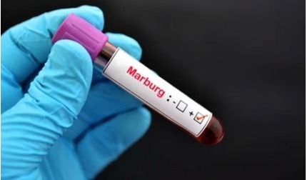 WHO lên tiếng cảnh báo đại dịch virus Marburg có thể bùng phát trên toàn cầu