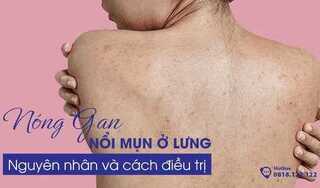 Nóng gan nổi mụn ở lưng: Nguyên nhân và cách điều trị