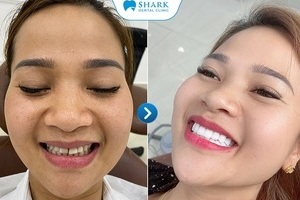 Bọc răng sứ nguyên hàm là gì? Bọc răng sứ nguyên hàm giá bao nhiêu?