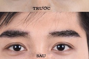 Cấy lông mày là gì? Tiêu chí lựa chọn địa chỉ cấy lông mày an toàn