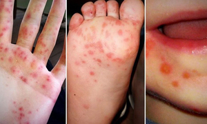 Xác định được tác nhân gây bệnh tay chân miệng nặng ở trẻ em