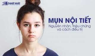 Mụn nội tiết: Nguyên nhân, triệu chứng và cách điều trị