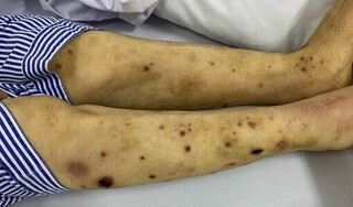 Nghe lời thầy lang cho ong đốt để chữa bệnh, người phụ nữ phải nhập viện